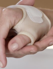 A Simple Splint for RA Can Make a Difference A Simple Splint for RA Can Make a Difference