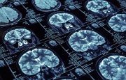 What to Expect From an MRI for RA