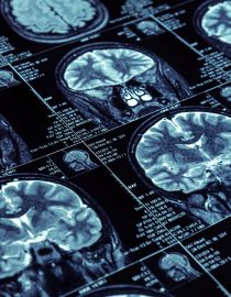 Early Rheumatoid Arthritis Detection Through MRI Early Rheumatoid Arthritis Detection Through MRI