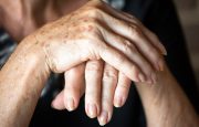 Rheumatoid Arthritis in Fingers and Hands