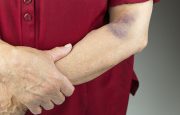Rheumatoid Arthritis Bruising