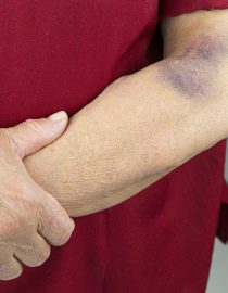 Rheumatoid Arthritis Bruising: How to Cover and Care for a Bruise and More